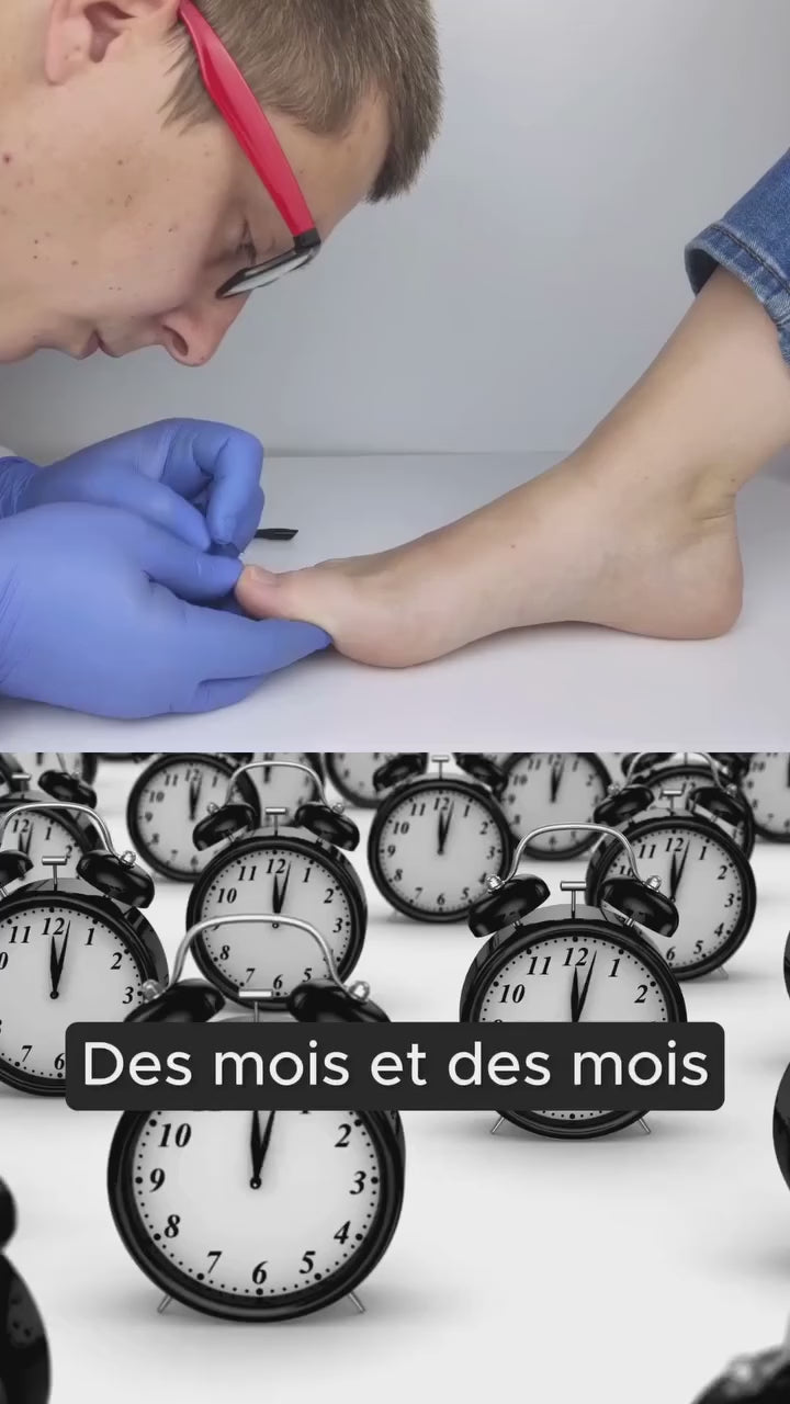 Charger la vidéo : &lt;p&gt;Découvrez comment notre appareil anti-mycose utilise la technologie laser pour cibler et éliminer les champignons responsables. &lt;/p&gt;&lt;p&gt;Traitement indolore, à domicile, sans médicament &lt;br/&gt;&lt;br/&gt;&lt;/p&gt;